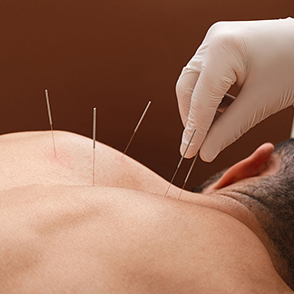 Acupuncture