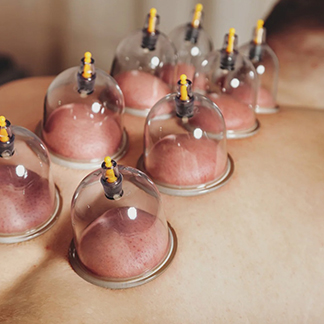 Cupping